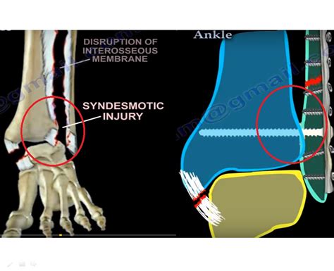 Syndesmotic Injuries Of The Ankle 